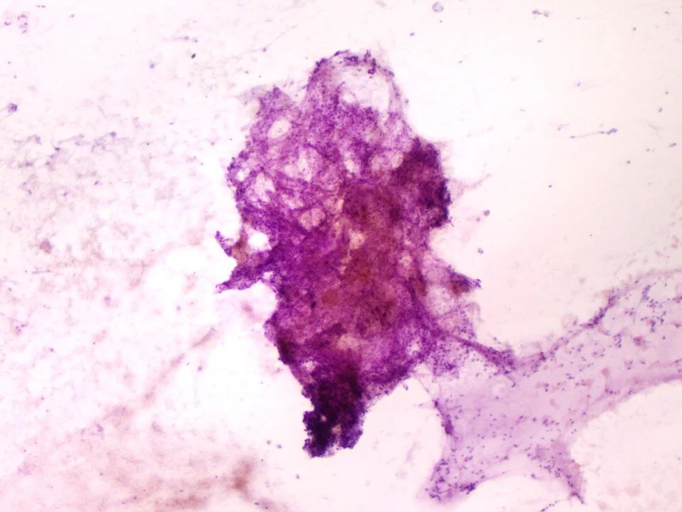 Organizing pneumonia