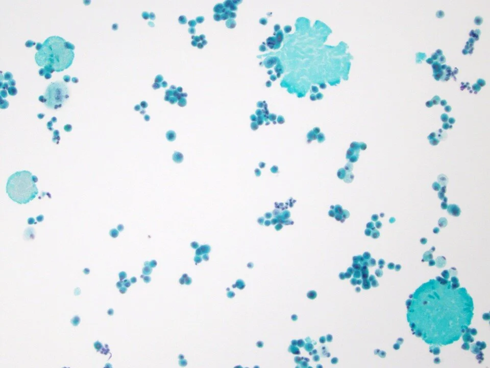 Pulmonary alveolar proteinosis