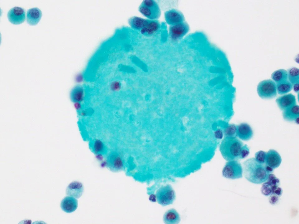 Pulmonary alveolar proteinosis