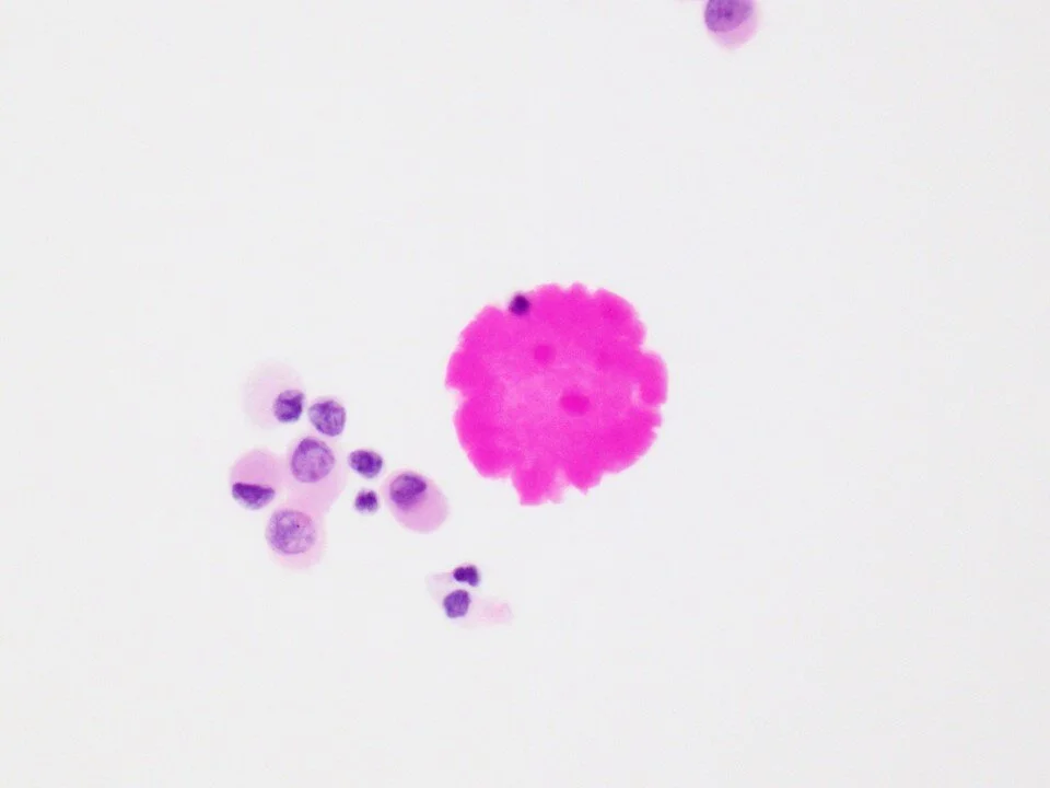 Pulmonary alveolar proteinosis
