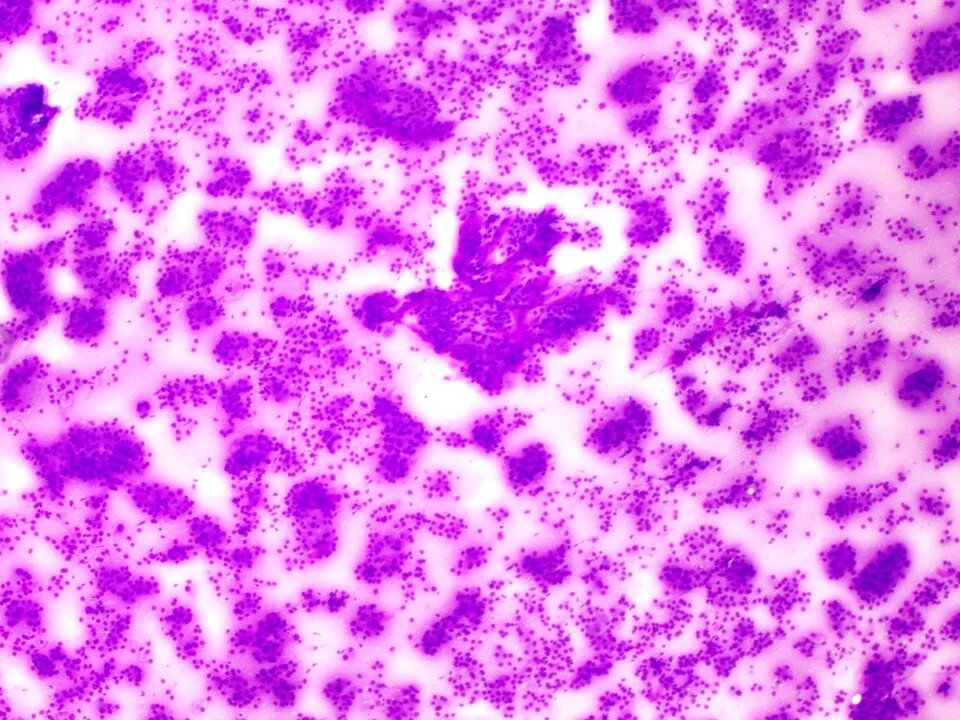 Sclerosing pneumocytoma