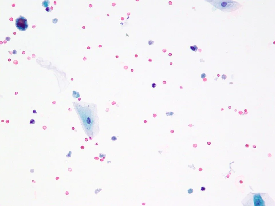 Voided urine - hematuria