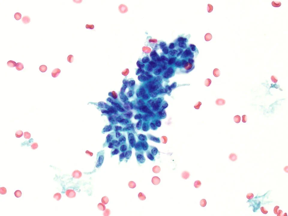 Cystitis glandularis