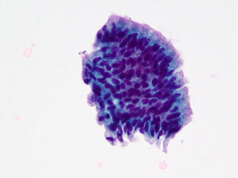 Cystitis glandularis