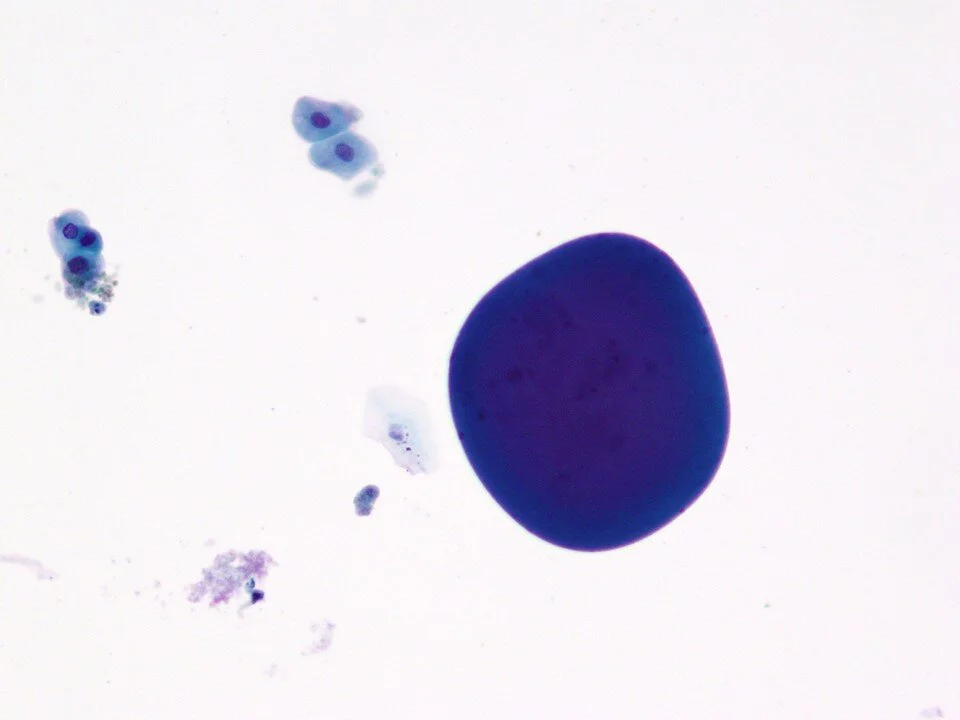 Seminal vesicle cells (left) and corpora amylacea (right)