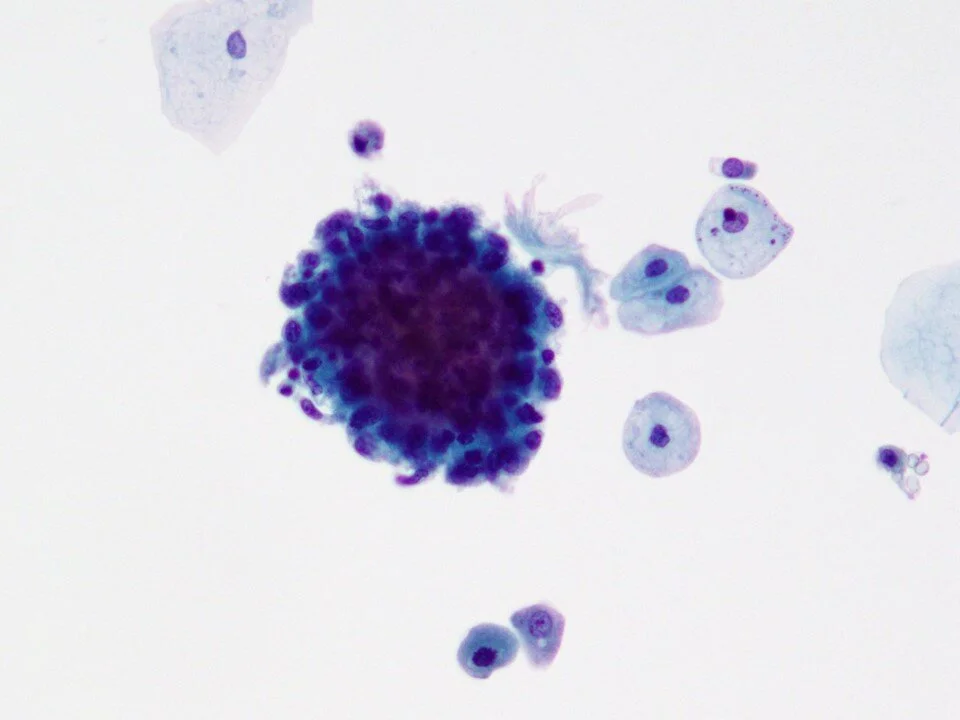 Granulomatous inflammation