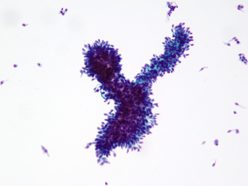 Low Grade Urothelial Neoplasm