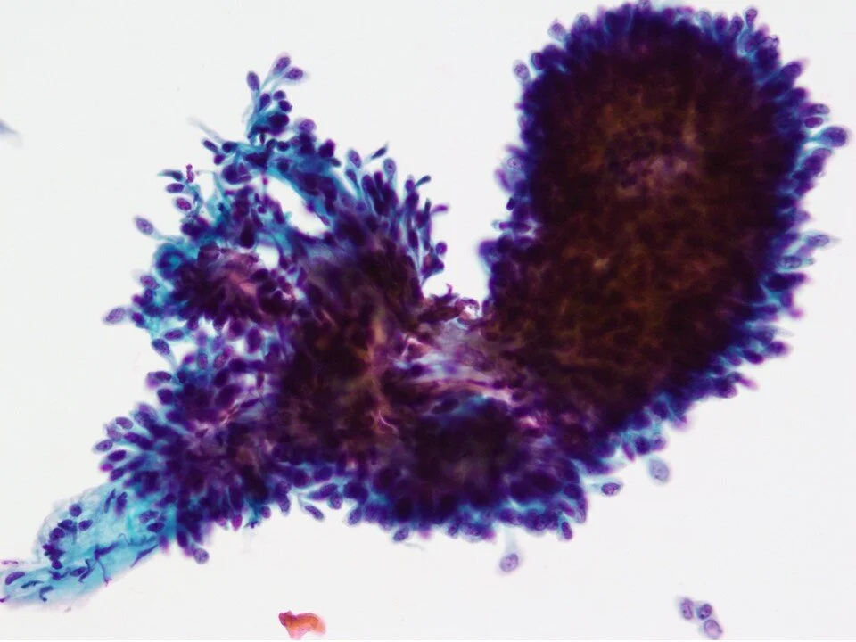Low Grade Urothelial Neoplasm