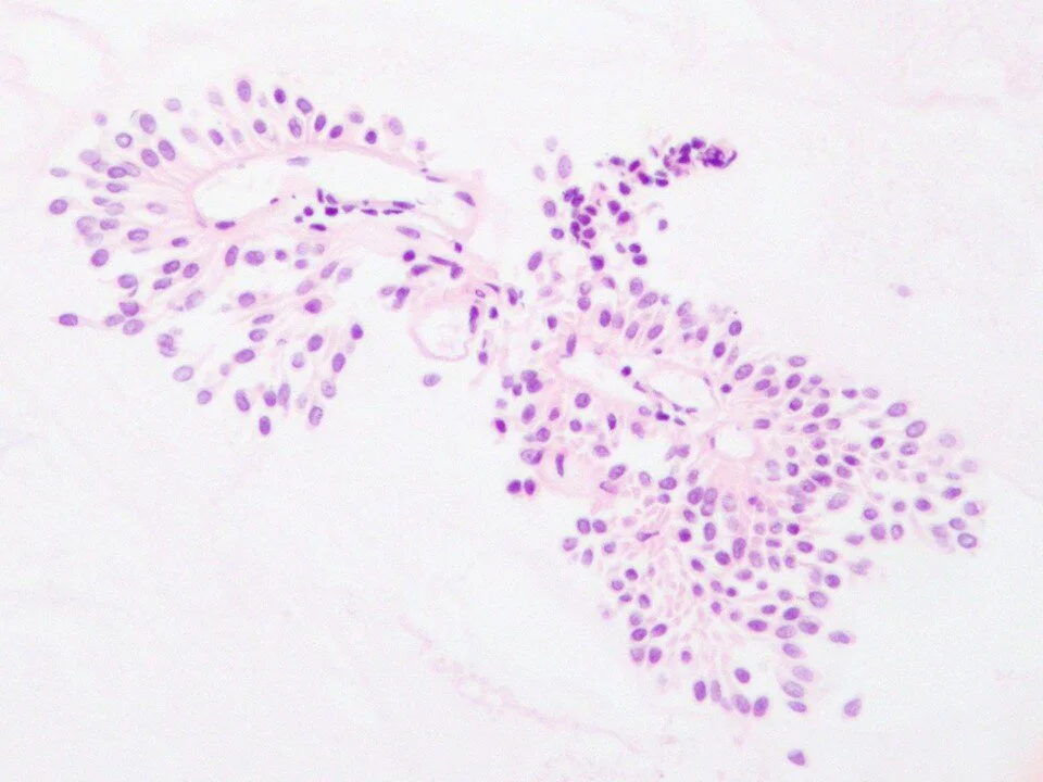 Low Grade Urothelial Neoplasm - Cell Block