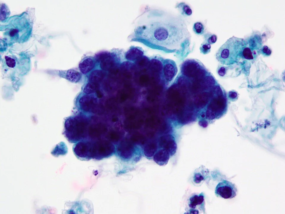 High Grade Urothelial Carcinoma