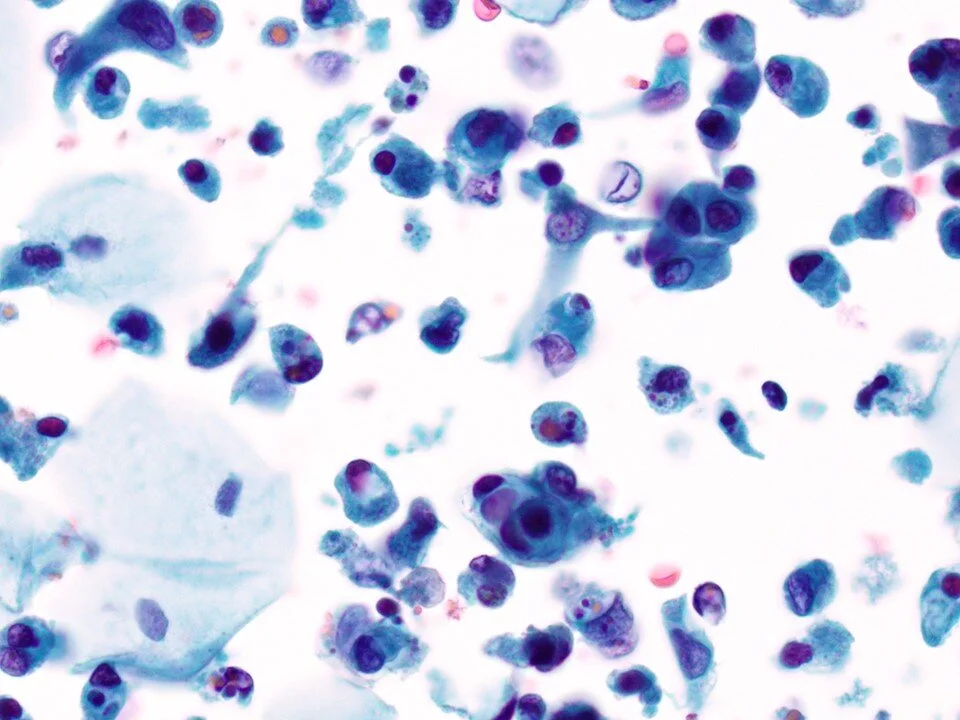High Grade Urothelial Carcinoma