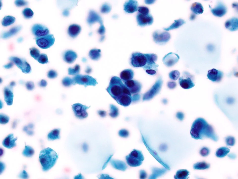 High Grade Urothelial Carcinoma