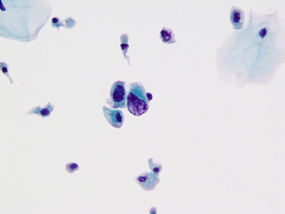 High Grade Urothelial Carcinoma