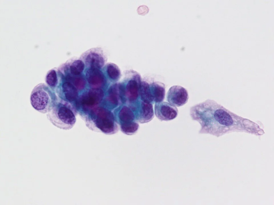 Nephrogenic adenoma