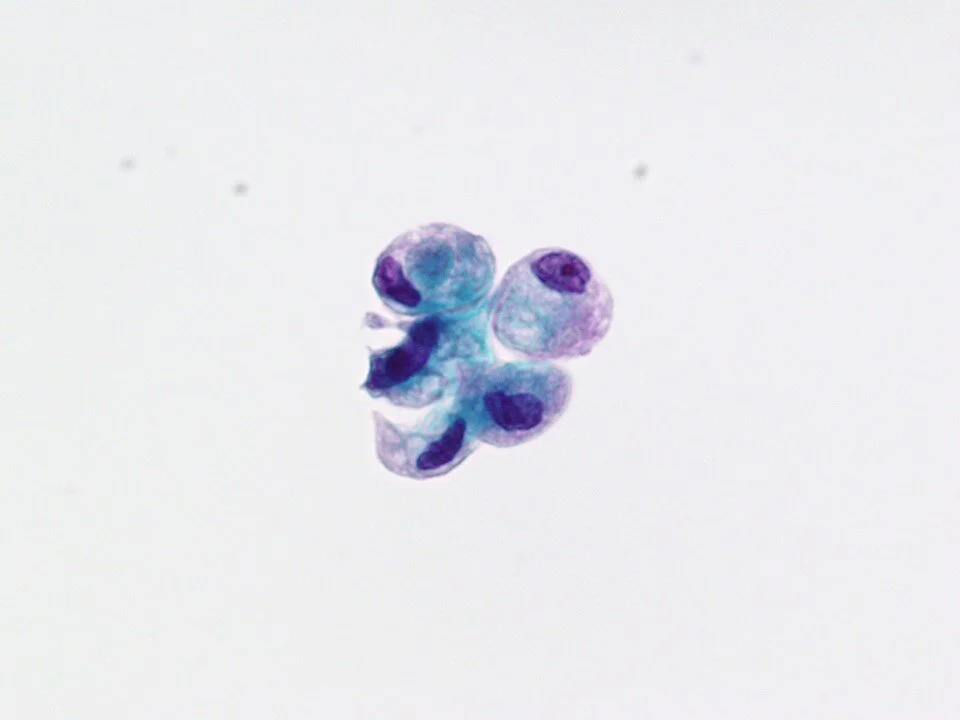 Nephrogenic adenoma