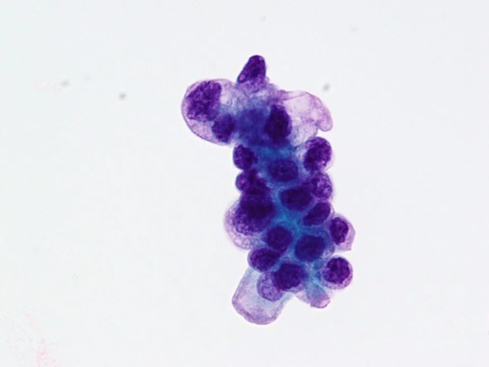 Metastatic lung adenocarcinoma