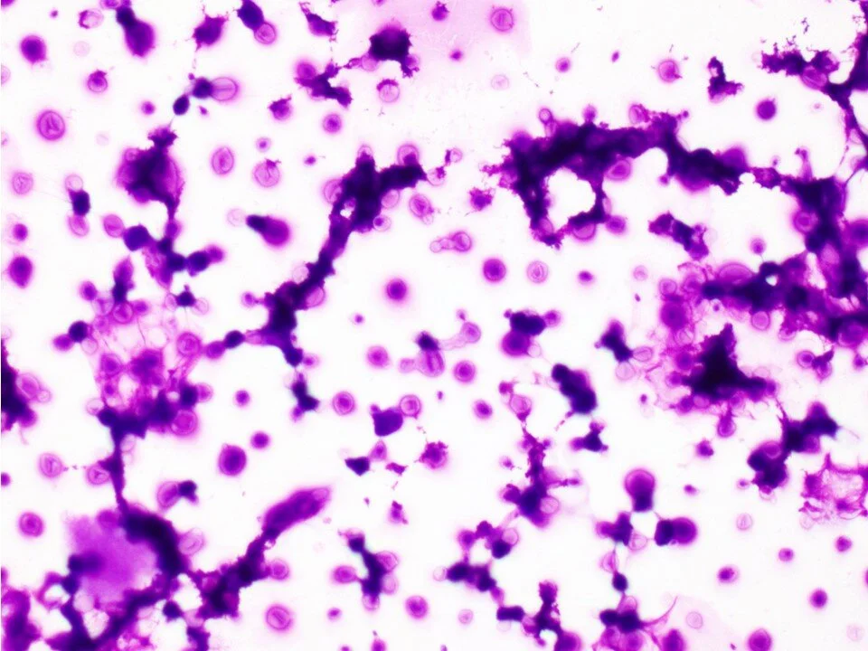 Cryptococcus Neoformans