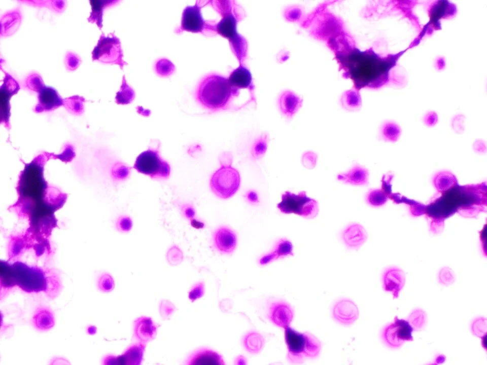 Cryptococcus Neoformans