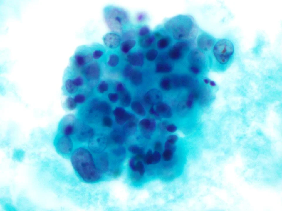 Choroid plexus carcinoma