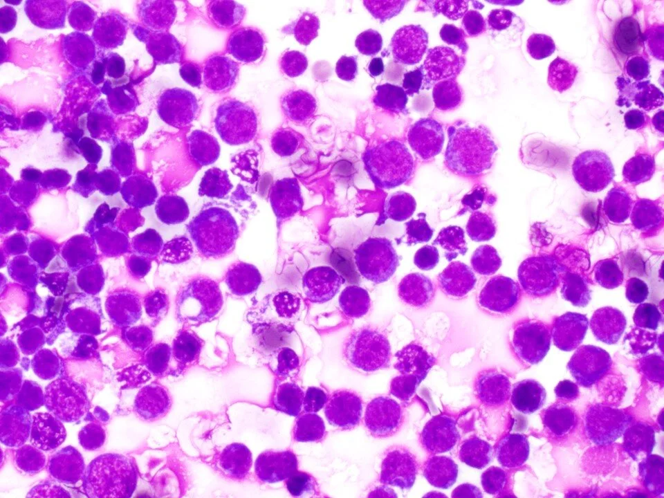 Diffuse Large B Cell Lymphoma