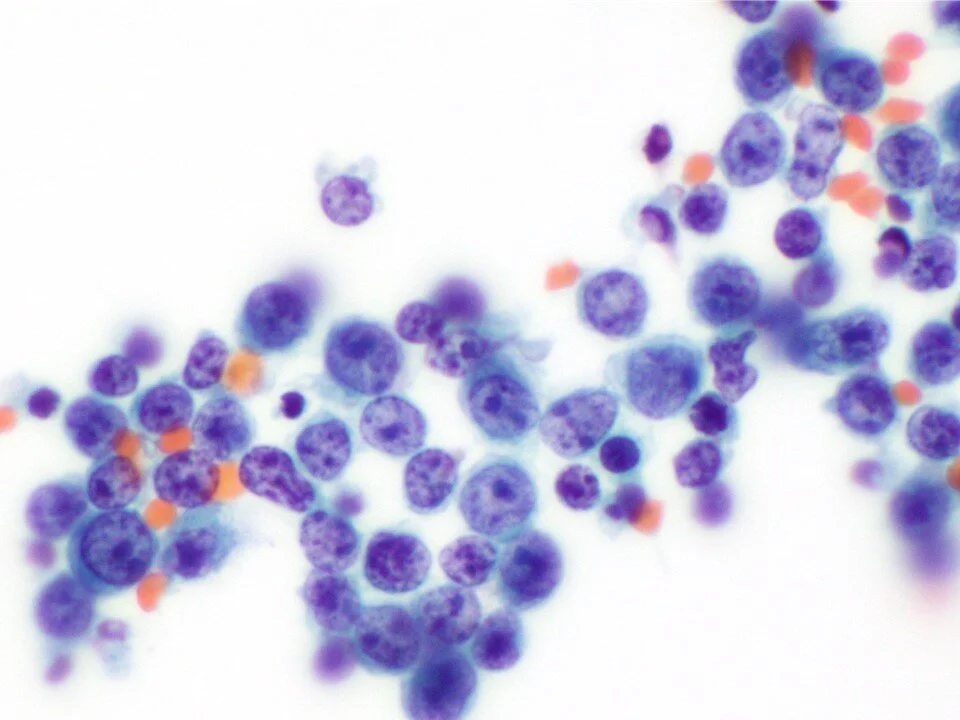 Diffuse Large B Cell Lymphoma