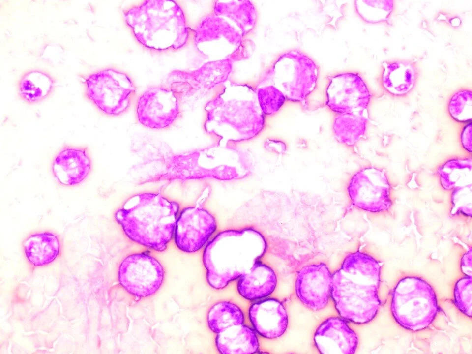 T lymphoblastic lymphoma