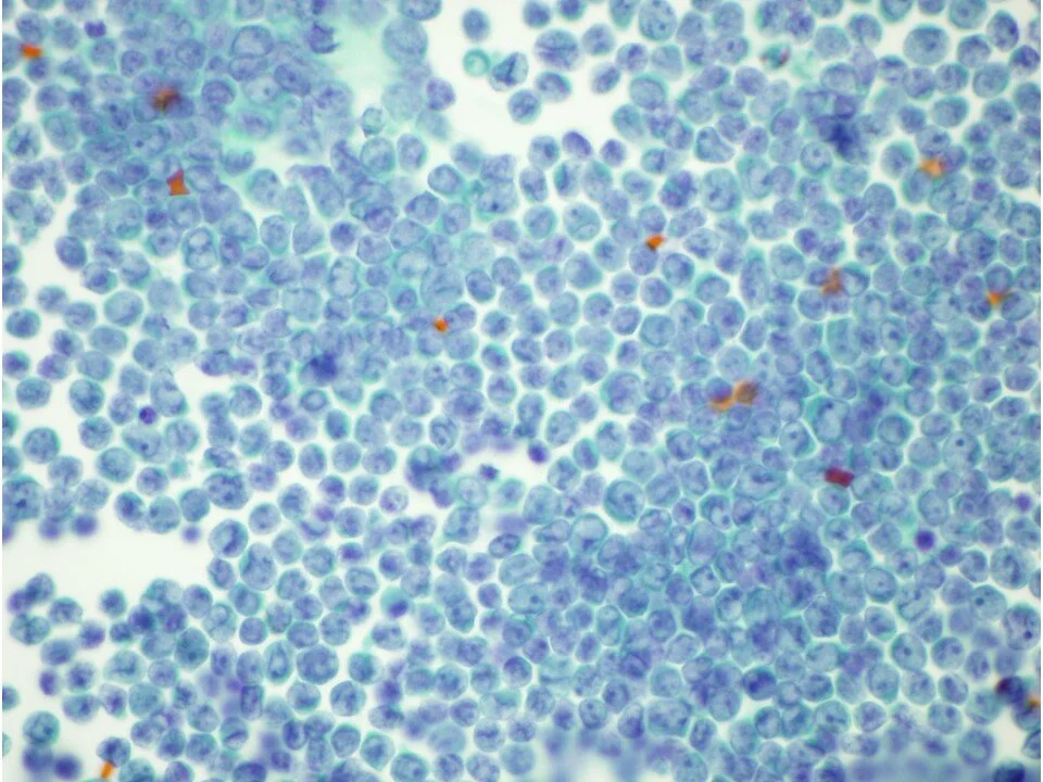 Acute Myelogenous Leukemia