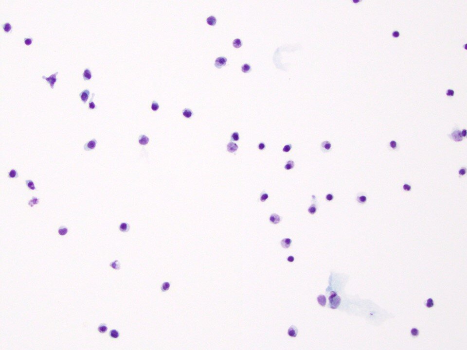 Chronic Lymphocytic Leukemia