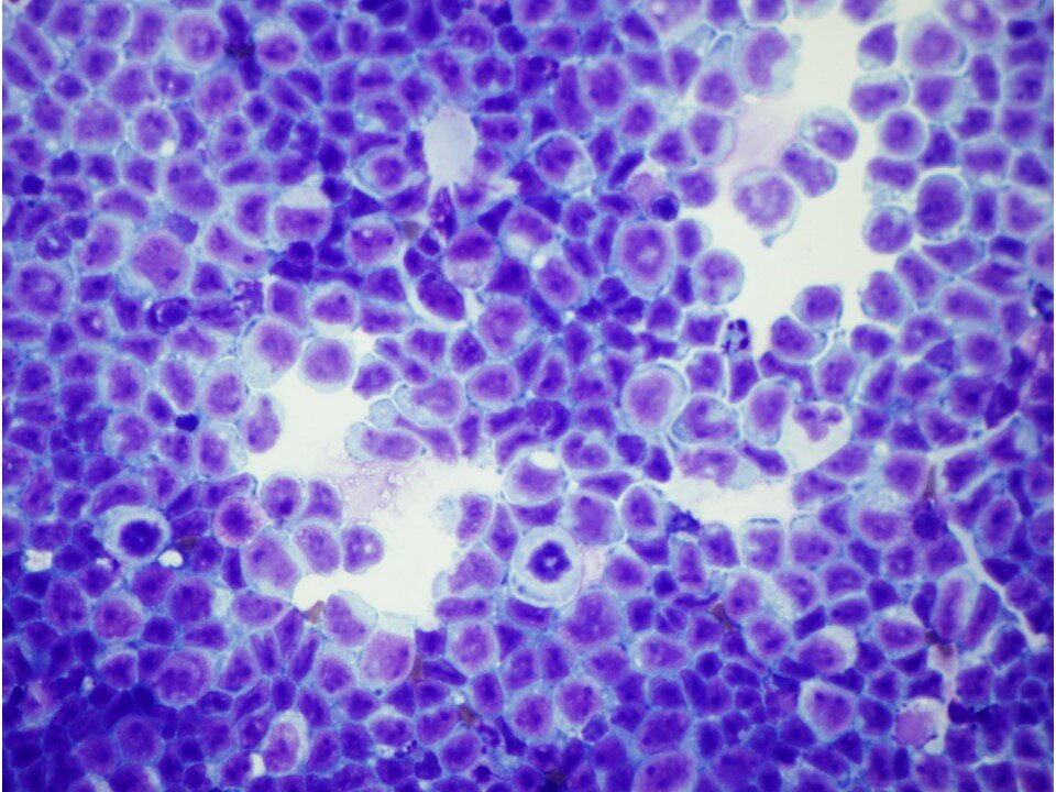 Acute Myelogenous Leukemia