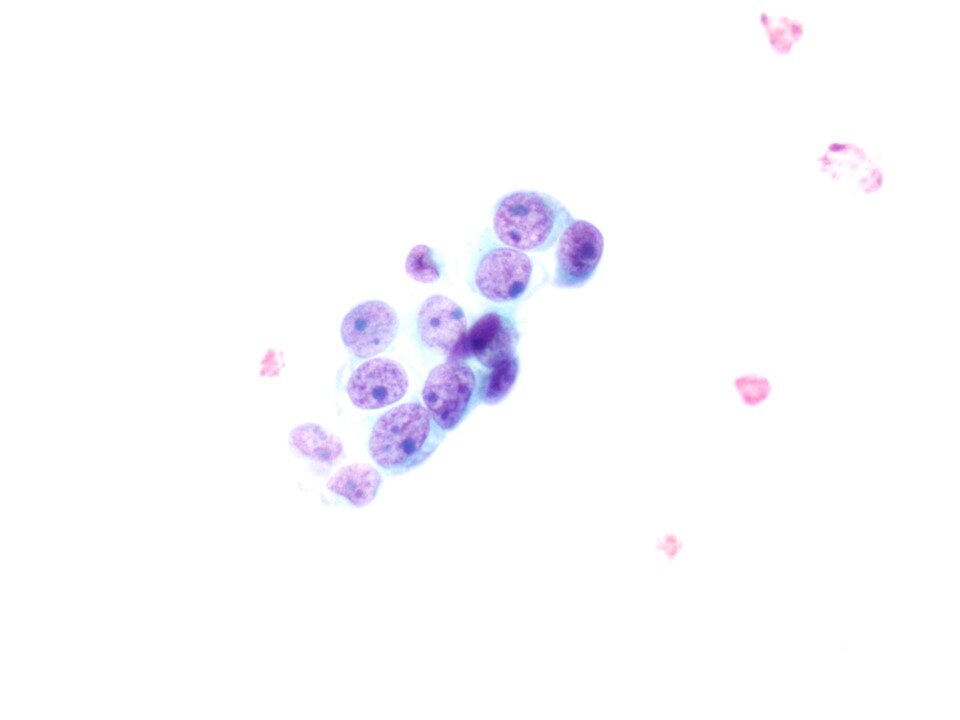 Metastatic Rhabdomyosarcoma
