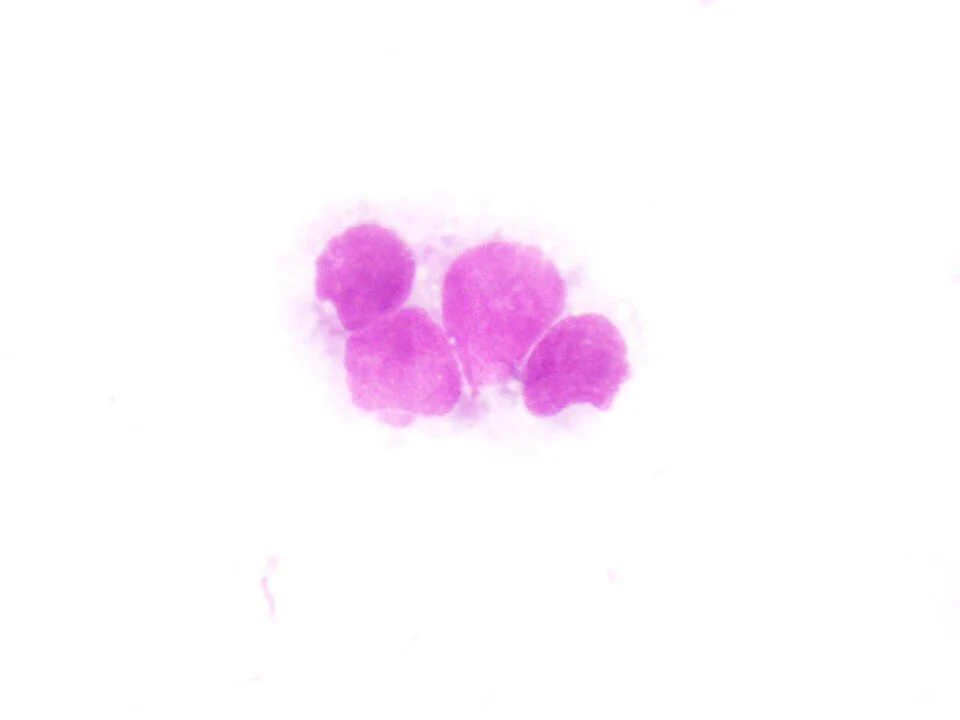 Metastatic Small Cell Carcinoma