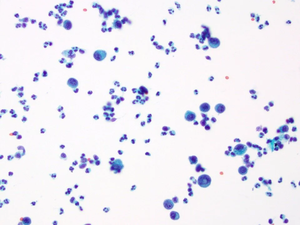 Metastatic Gastric Signet-Ring Cell Carcinoma