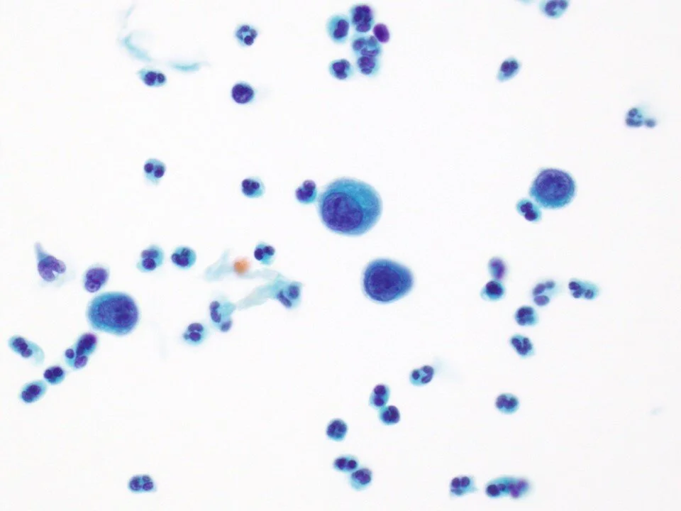 Metastatic Gastric Signet-Ring Cell Carcinoma