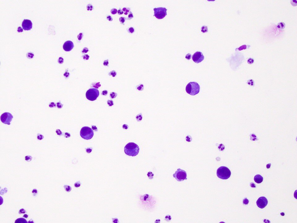 Metastatic Gastric Signet-Ring Cell Carcinoma