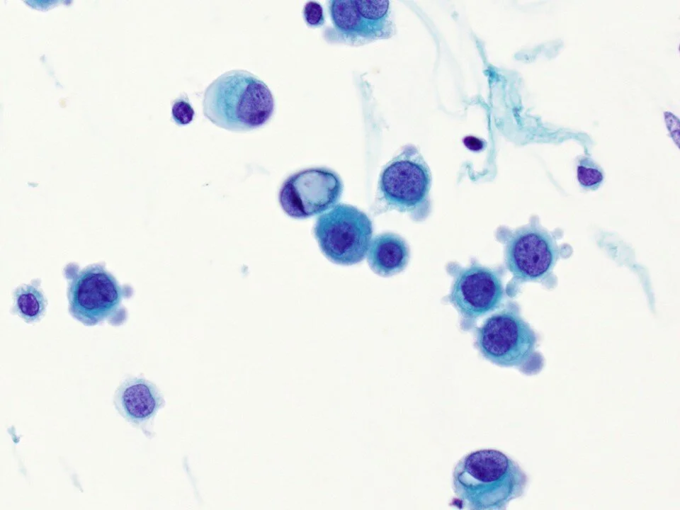 Metastatic Lobular Breast Carcinoma