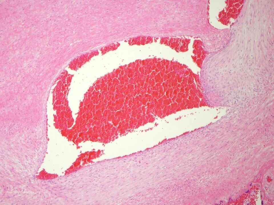Chorionic plate vessel with intramural fibrin deposition