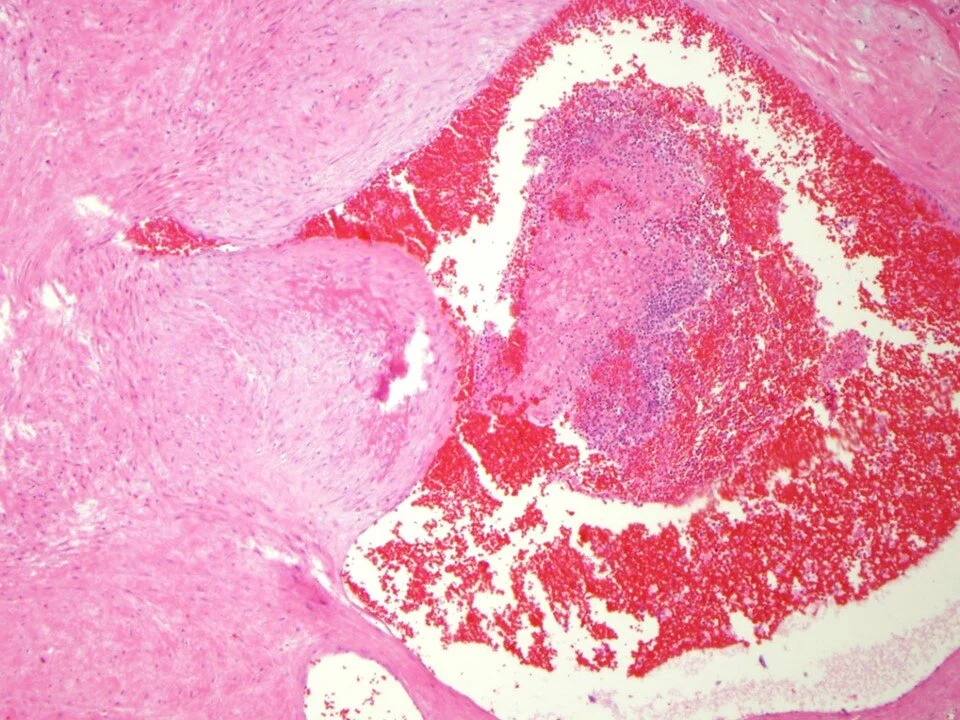 Chorionic plate vessel with intramural fibrin deposition and loose non-occlusive thrombus