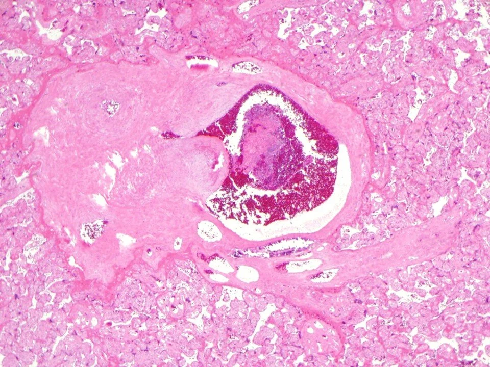 Stem villous vessel with intramural fibrin deposition