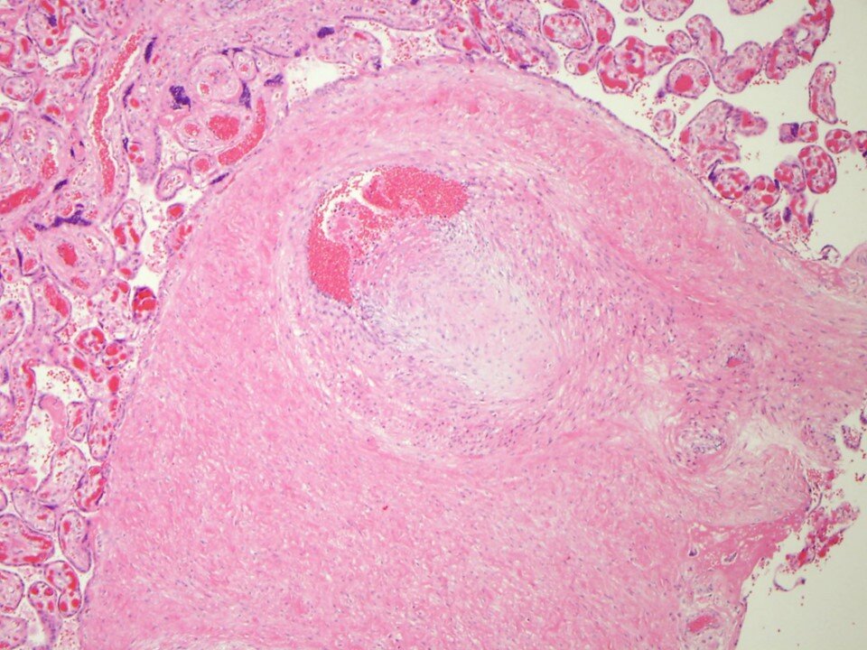 Stem villous vessel with intramural fibrin deposition