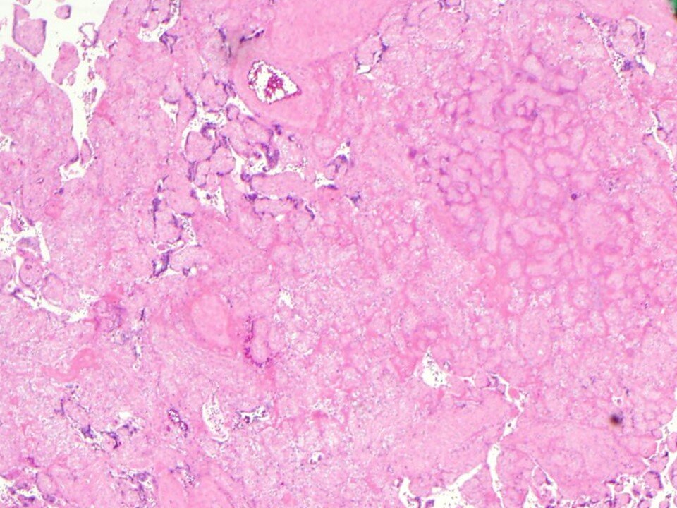 Placental Infarct