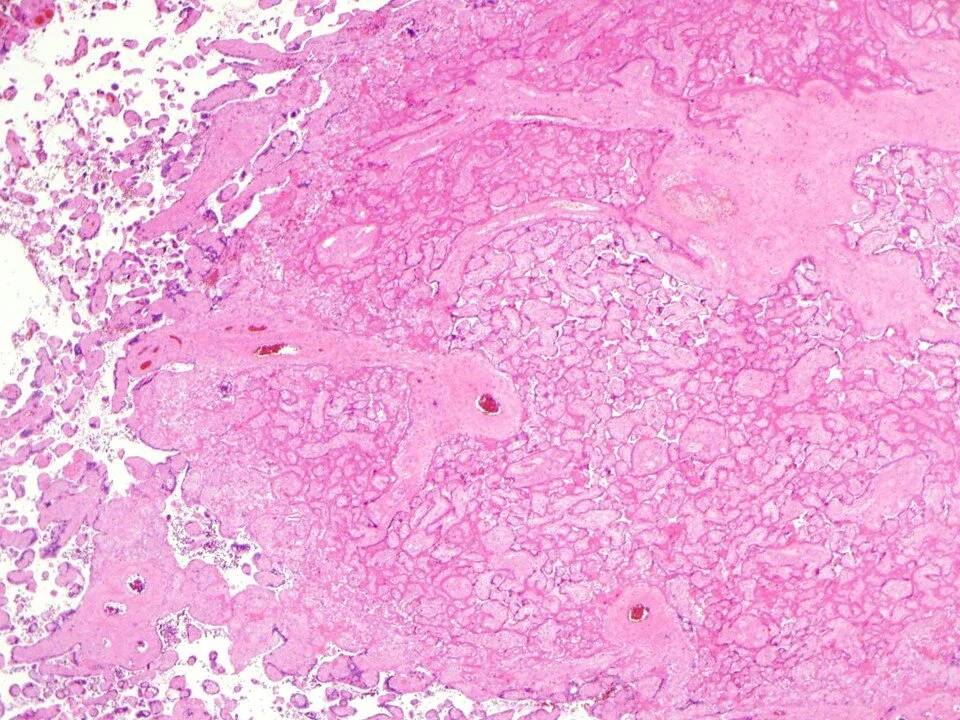 Placental Infarct