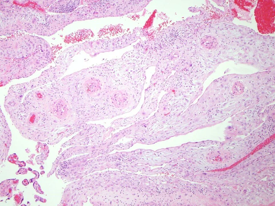 Decidual Arteriopathy - Hypertrophic Type