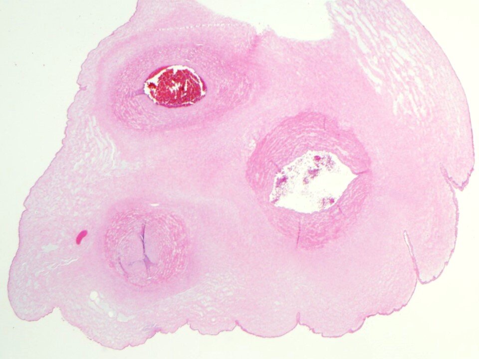 Thin Umbilical Cord - <8mm