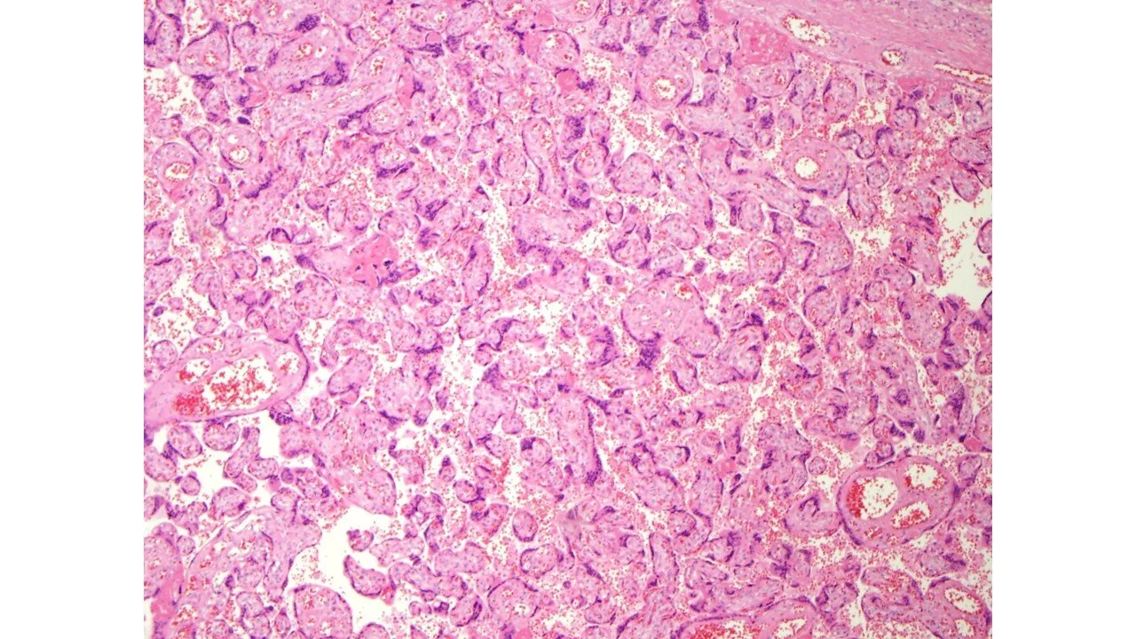 Increased Syncytial Knots