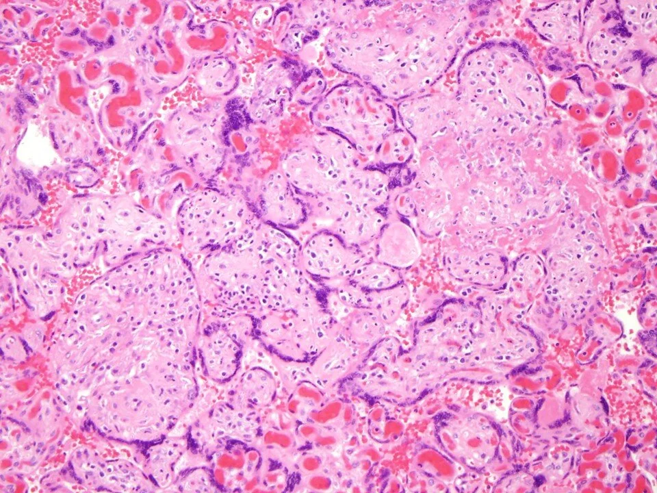 Villitis of unknown etiology