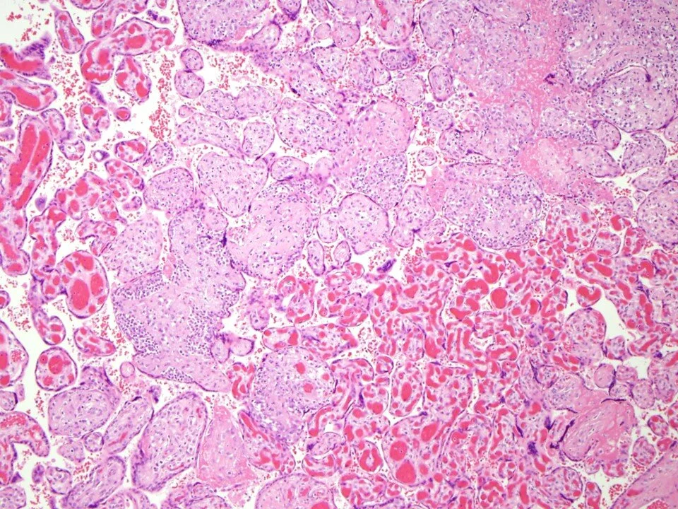 Villitis of unknown etiology