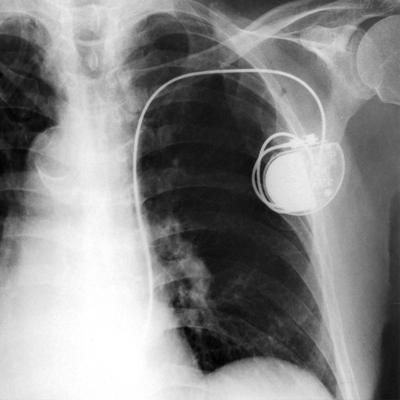 pacemaker.png