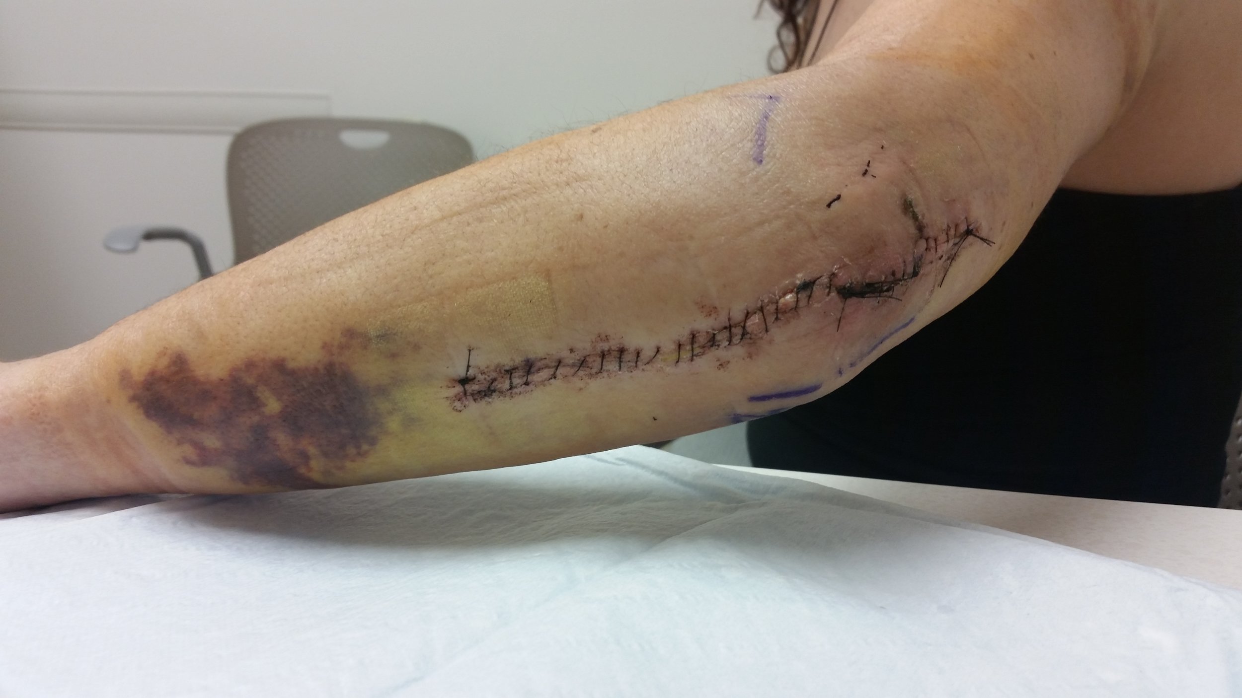 My left arm, after removal of the cast from my first surgery, October 2015.