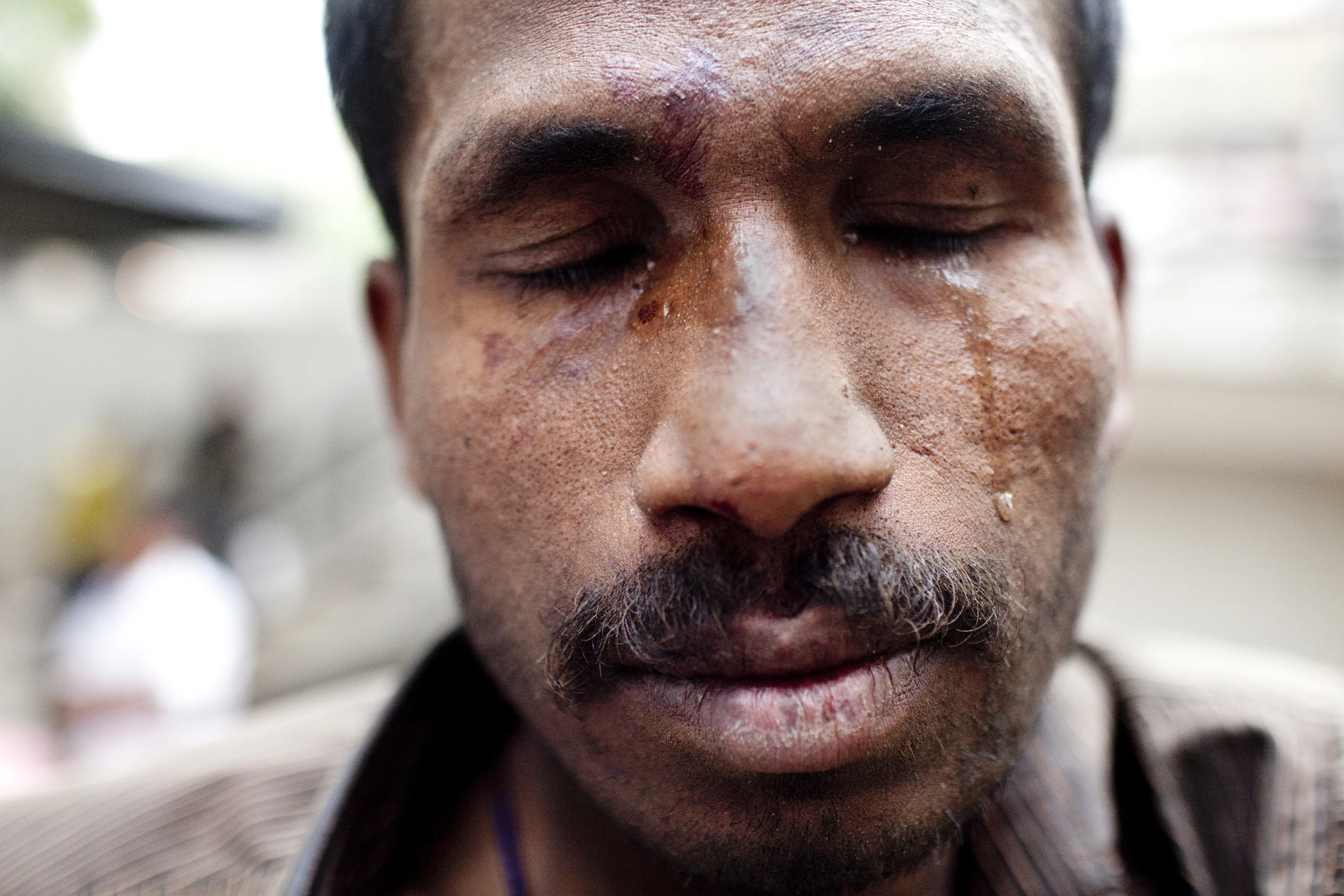   Rajendara cries after having a wound cleaned and mended at the Yamuna Bazaar in New Delhi, India, on May 17, 2012. Without money or his own drugs, Rajendara stole from another user, who then broke a bottle over his arm. The 2-square-mile Yamuna Baz
