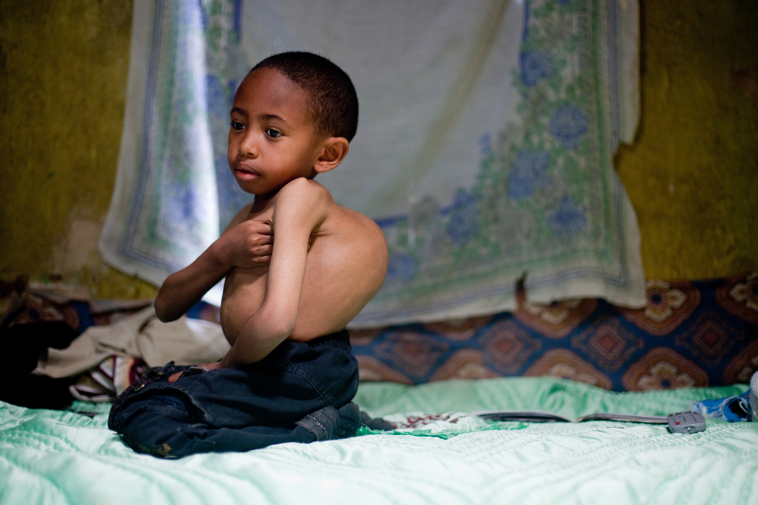  Sisay Gudeta, then age 7, sits on his bed at his home in Addis Ababa, Ethiopia, May 2013. At the time, his spine curved about 120 degrees. Without surgery, Sisay's scoliosis would have killed him before age 18, doctors said. 
